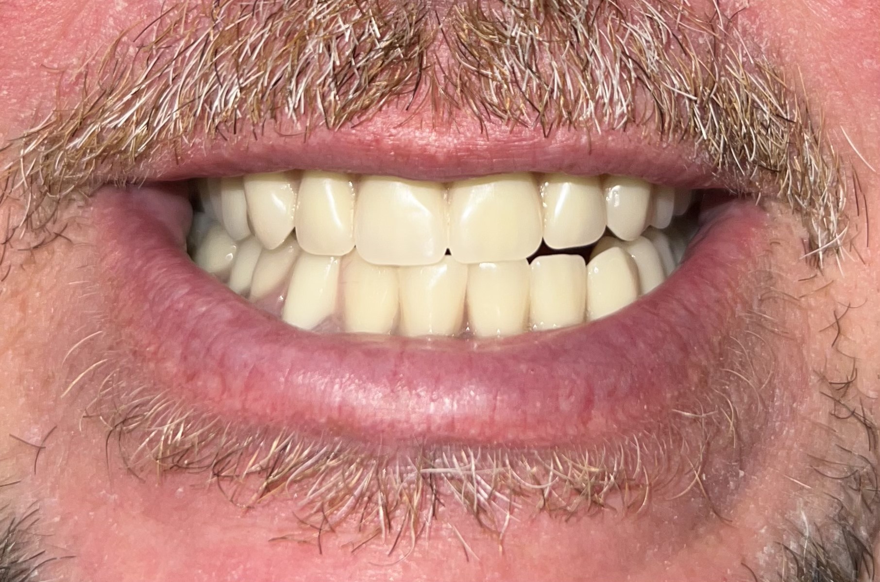 Rob Snap-On Implant Dentures | Cleveland Smile Center